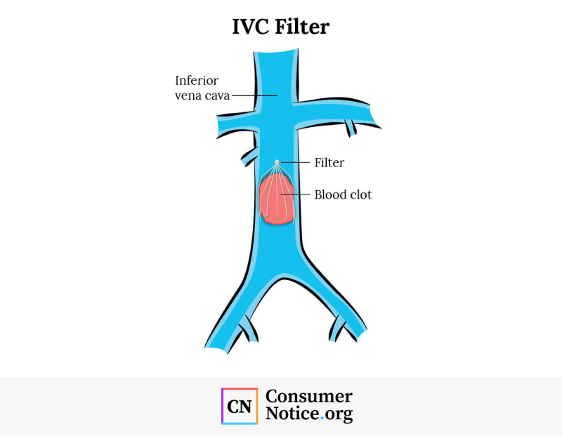 فیلتر امبولی IVC